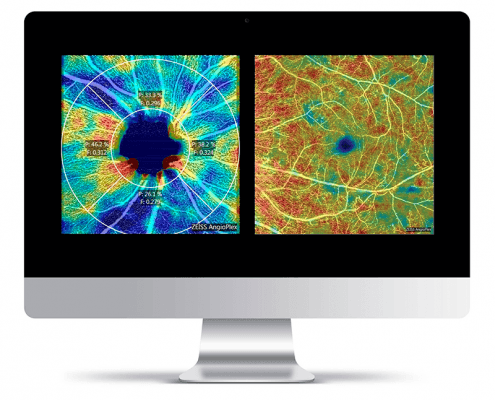 Bildschirmansicht einer OCT-Angiografie der Netzhaut