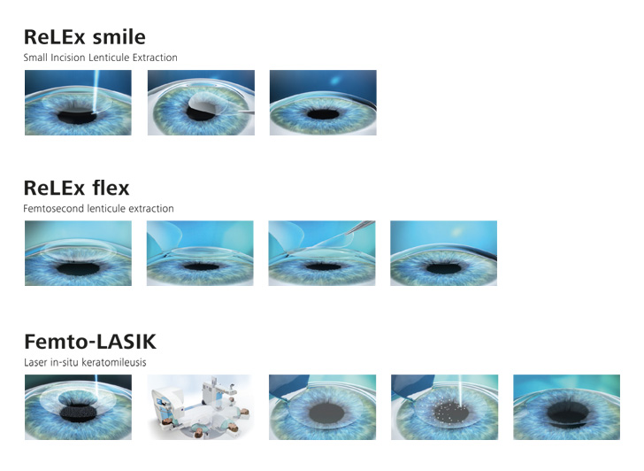 Коррекция зрения смайл цена со скидкой спектр. Лазерная коррекция методом Фемто ласик. Лазерная коррекция RELEX smile. Ласик Смайл коррекция зрения. ФРК ласик Фемто ласик и Смайл.